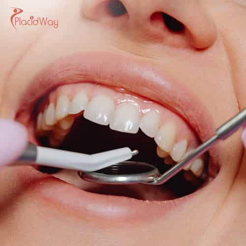 Dental Implants in Costa Rica: An Affordable Option for Canadian Patients